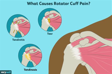 A rotator cuff tear causes shoulder pain and limits movement of the. . Can rotator cuff injury cause breast pain